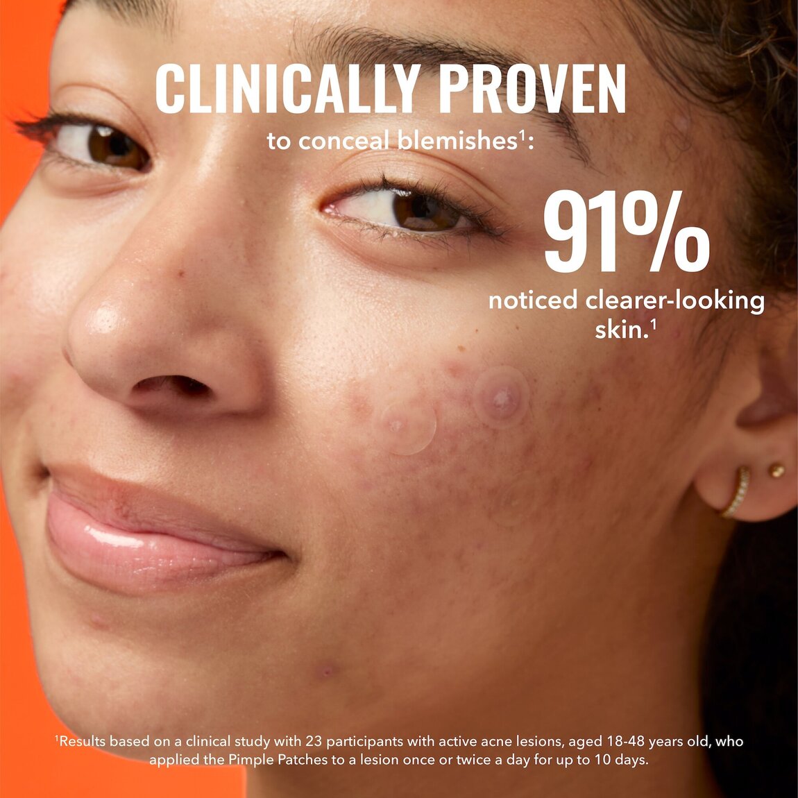 pimple-patches-r2 zb_p.jpg