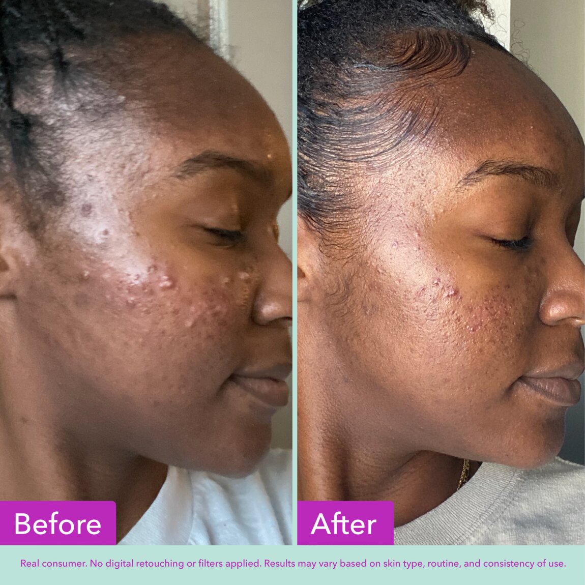 acne-foaming-cleanser-s8 zb_p.jpg